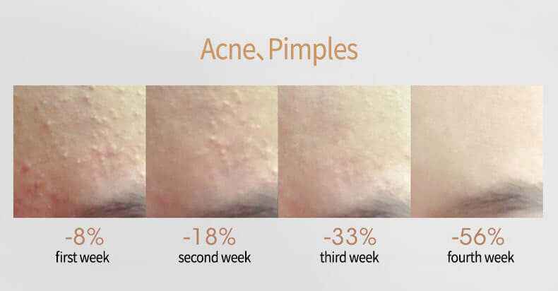 Acne Removal Oil – Salicylic Acid Skincare