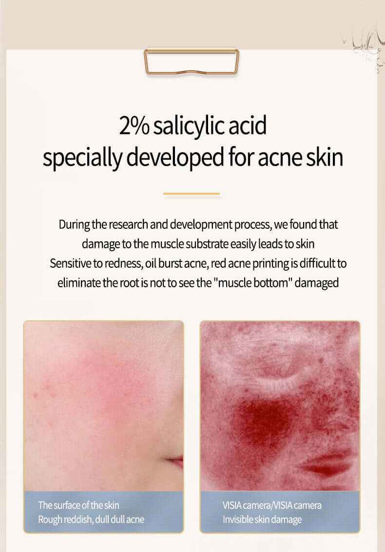Acne Removal Oil – Salicylic Acid Skincare